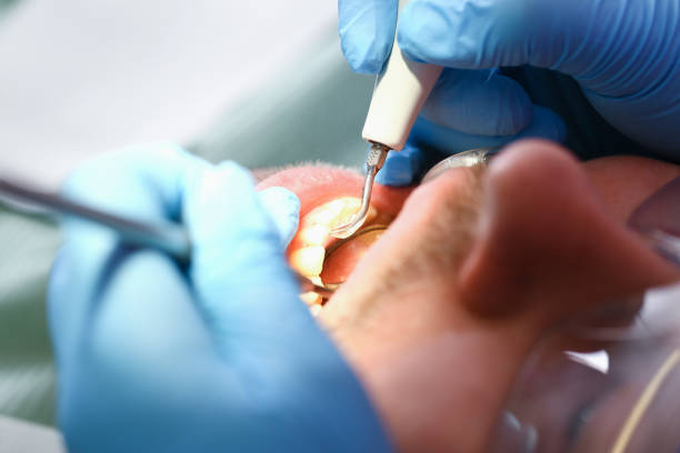 Best Emergency Tooth Extraction in Nixa, MO